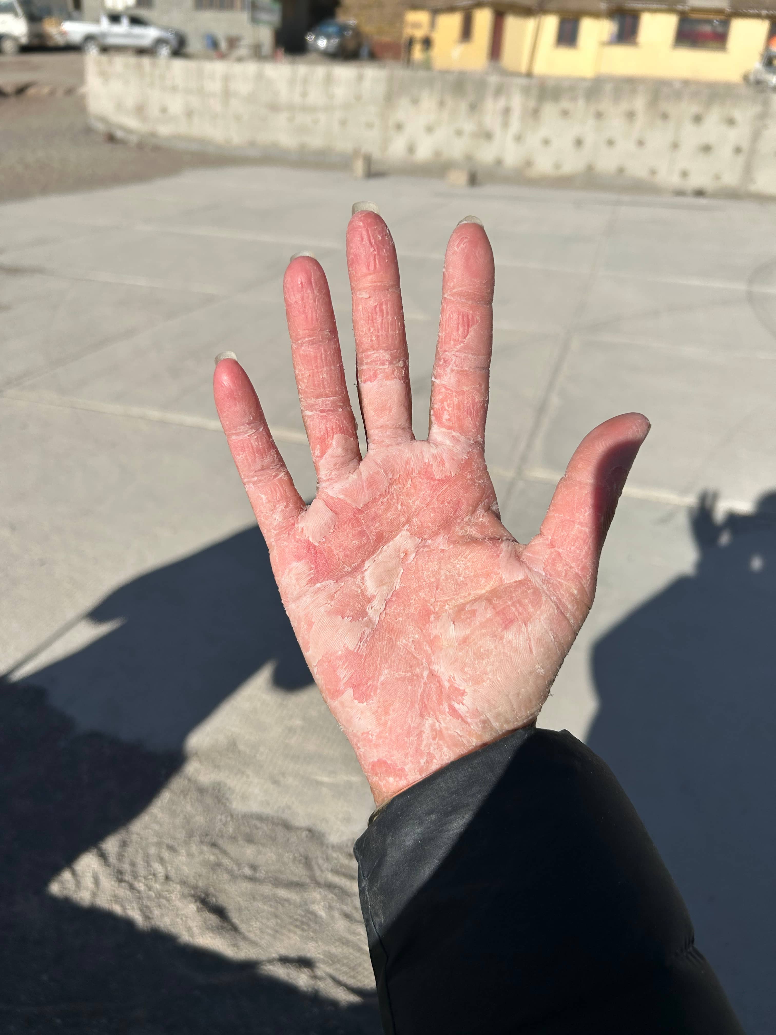 During eczema